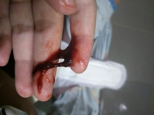 เพิ่งผ่าคลอดได้10กว่าวัน