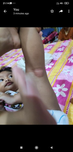 Kulit baby naik parut