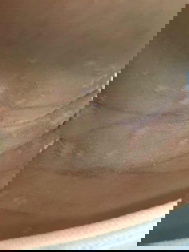 rashes on neck