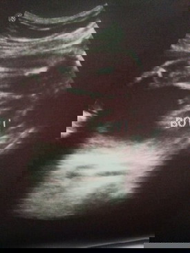 Pwede po ba magkamali ang ultrasound?