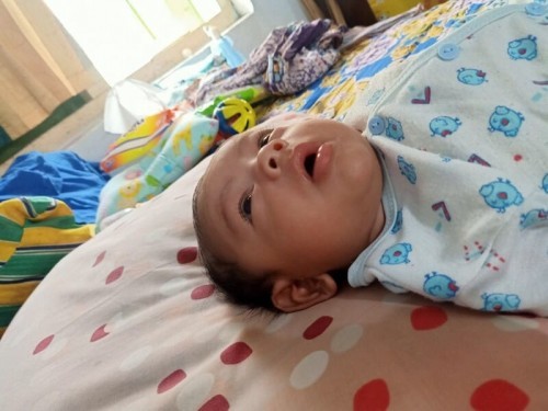 penyebab mata bayi juling