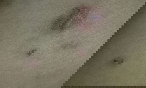 เป็นผื่นคัน