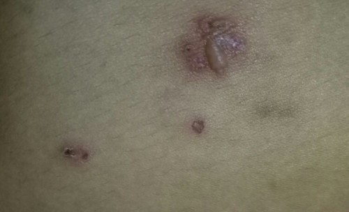 เป็นผื่นคัน