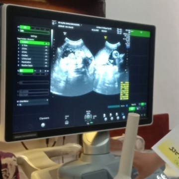 Hasil USG bayi