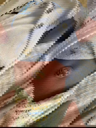 umbilical cord didn’t drop off properly