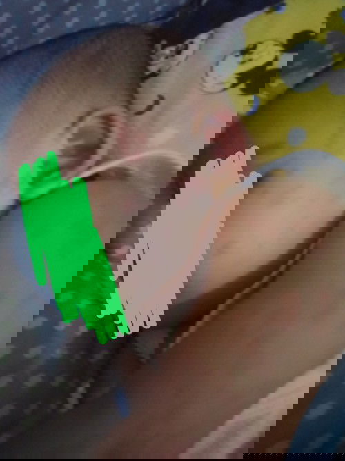 Ruam merah seluruh tubuh bayi