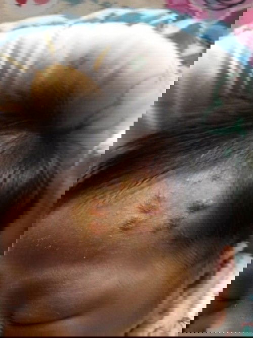 หัวลูกน้อยเป็นตุ่มๆ พอแตกออกก้อเป็นแผล