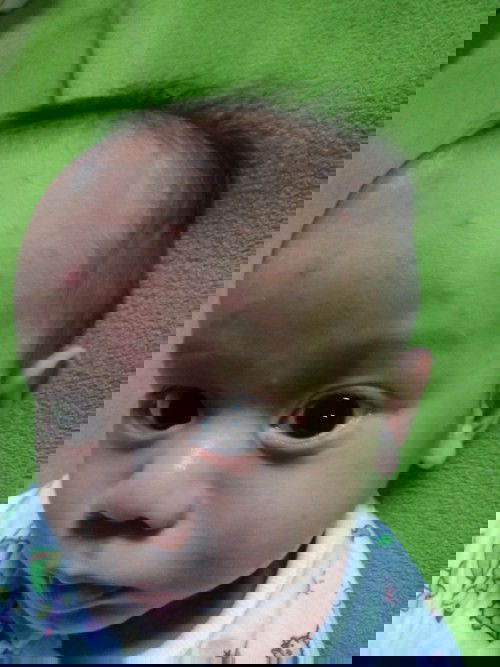 ตุ่มเเดงตามหน้าลูก