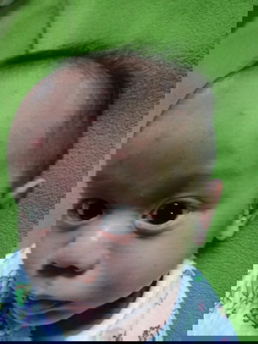 ตุ่มเเดงตามหน้าลูก