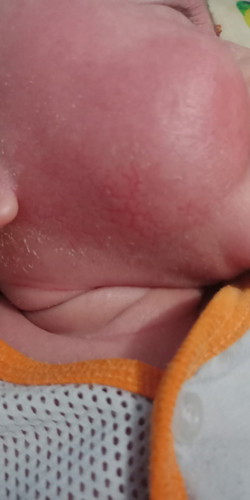 Hai mama2 Asian parents.
Nak tanya siapa ada anak ada masalah eczema. Boleh share pengalaman? Tq