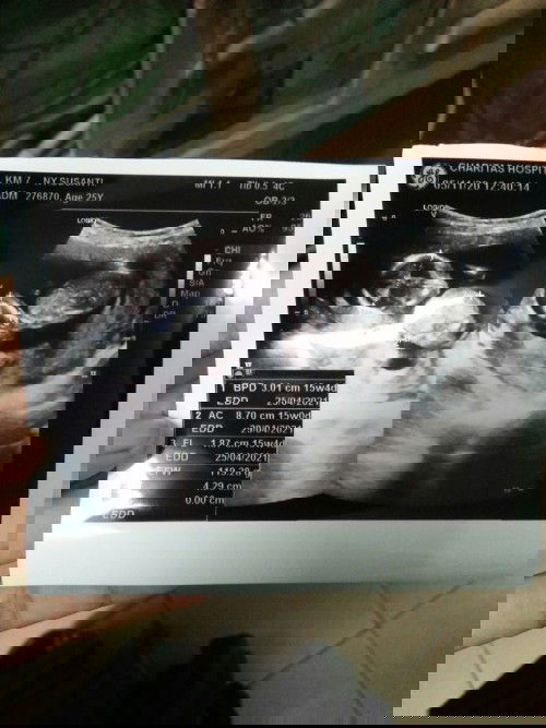 Pendarahan hebat pas hamil 4 bulan