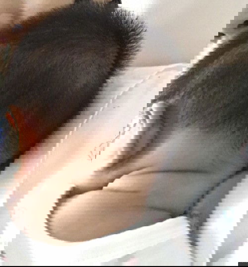 ผมลูกขึ้นน้อยตรงที่เคยเป็นผด ปกติไหมคะ