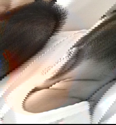 ผมลูกขึ้นน้อยตรงที่เคยเป็นผด ปกติไหมคะ