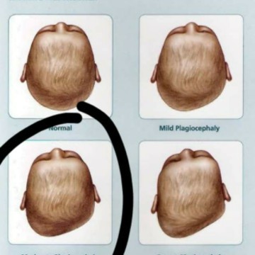 Plagiocephaly