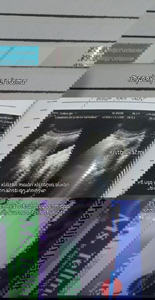 Flek kecoklatan emang selalu bikin khawatir