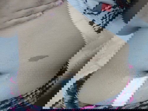 แผลผ่าคลอด