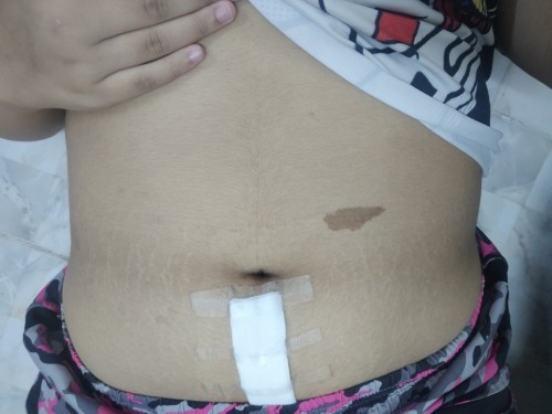 แผลผ่าคลอด