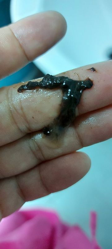 มูกเลือดสีดำ