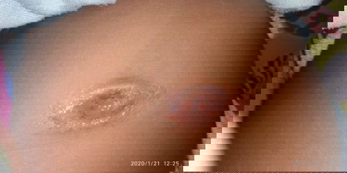 granuloma umbilikalis