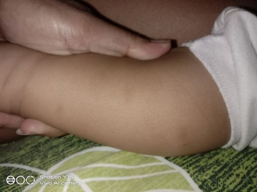 Peklat ni baby sanhi ng kagat ng langgam o lamok.