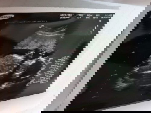 สงสัยเรื่องอายุครรภ์