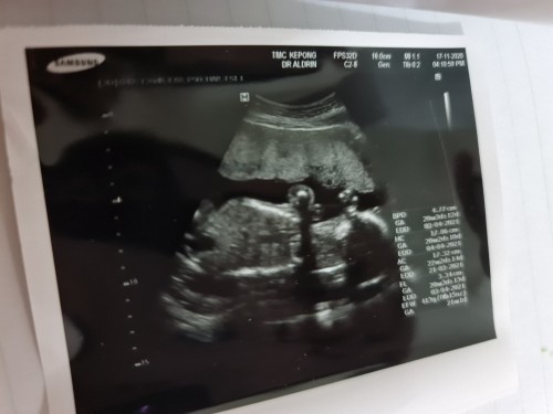 สงสัยเรื่องอายุครรภ์