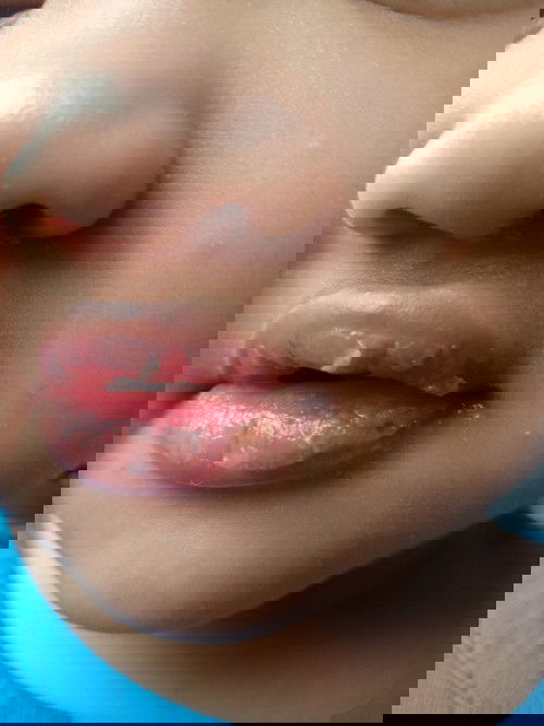 Lip therapy utk anak 2tahun 10 bulan..