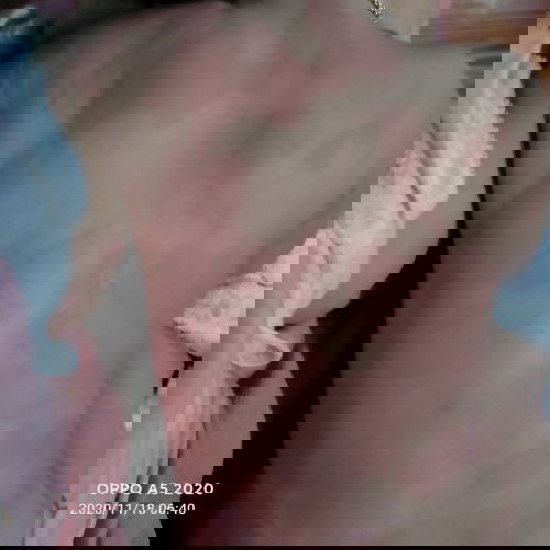 น้องเป็นผื่นอะไรก้อไม่รุ้ค่ะไปนอนโรงพยาบาลมา2คืนหายดีแล้วกับมาบ้านน้องก้อเป็นอีก