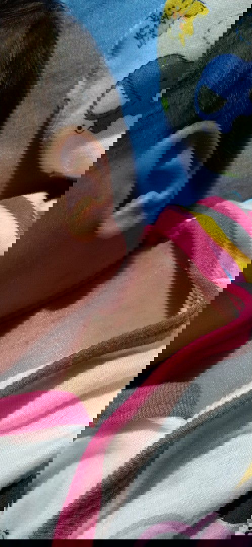 ลูกเป็นผดผื่นขึ้นแบบนี้ใช้อะไรถึงจะหายคะ