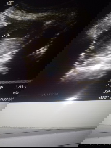 bunda2 dsni ad gak yg sm di mnggu k10 tp janin ny blm kliatn??doktr blng ini BO/blanted ovum,