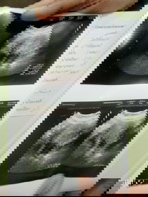 อายุครรภ์6สัปดาห์ หมอบอกว่า เด็กผิดปกติ คือ เด็กไม่โต ตามอายุครรภ์ เราปวดท้องมาก
ไม่มีเลือดออก