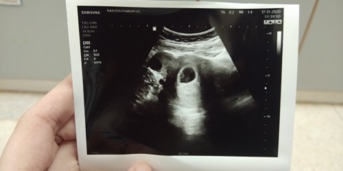 7week แล้ว แต่ยังไม่เห็นเด็กปกติไหมค่ะ