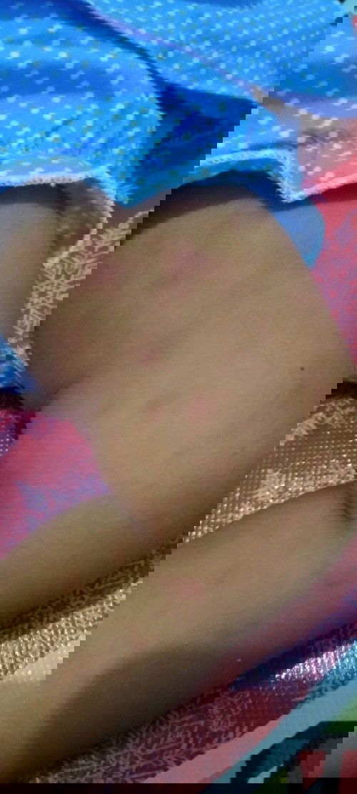 Bintik merah pada bayi