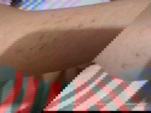 Kulit anak gatal, kering, merah