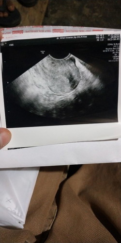 kemarin usg kata dokter belum ada tanda kehamilan tapi setelah saya testpack lgi hasil tetap positif