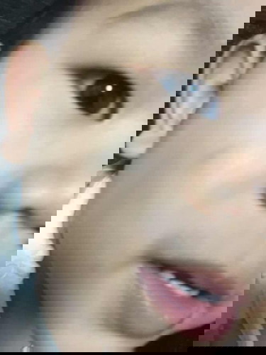 แก้มลูกมีรอยเขียว เกิดจากอะไร