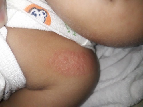 Rashes? Or not?