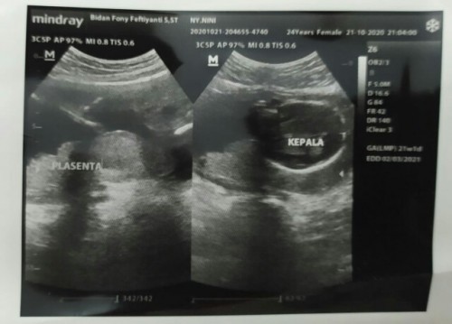 usia kehamilan ku udah 5bulan lebih tp jenis kelamin nya blm keliatan knpa ya bun. oh ya bun kata dokter plasenta saya berada dibawah deket jalan lahir apa bisa berubah ya supaya bisa lahiran normal🙁