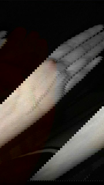 แบบนี้คืออะไรค่ะต้องไปพบคุณหมอมั้ยค่ะ