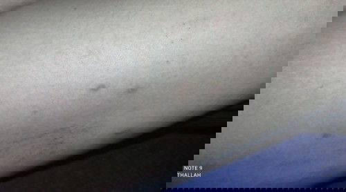 Gatal yang membandel ~