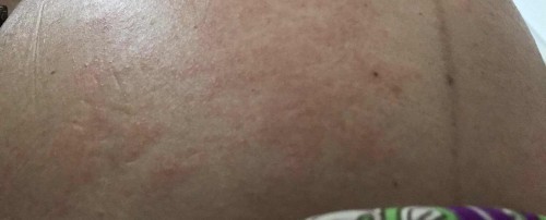 แม่ท้อง 27 week คันผื่น