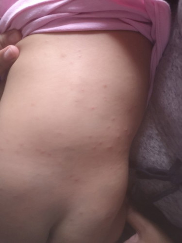 Tiny bumps