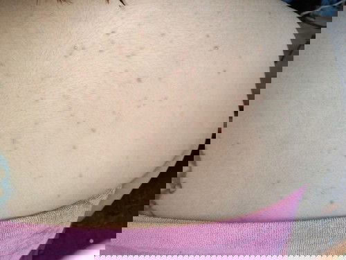 แม่ๆบ้านไหนสิวขึ้นหลังไหมค่ะ