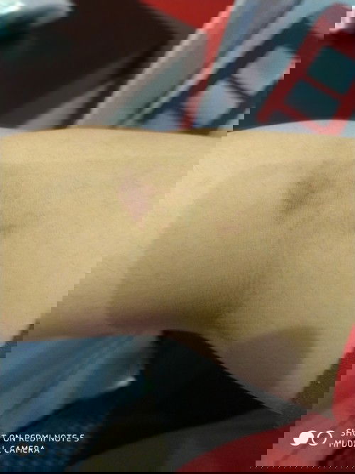 Lebam setelah cek darah