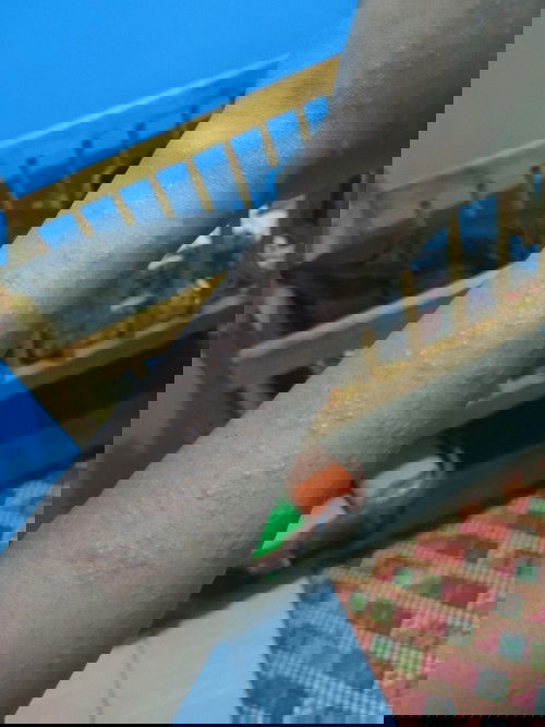 Alergi keringat debay