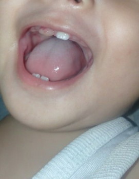 Nasira ang ngipin ni baby ko