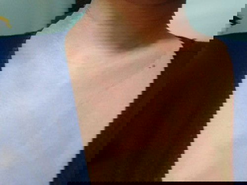 Badan Gatal ruam merah (Pupp atau apa