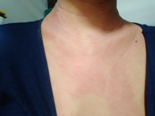 Badan Gatal ruam merah (Pupp atau apa