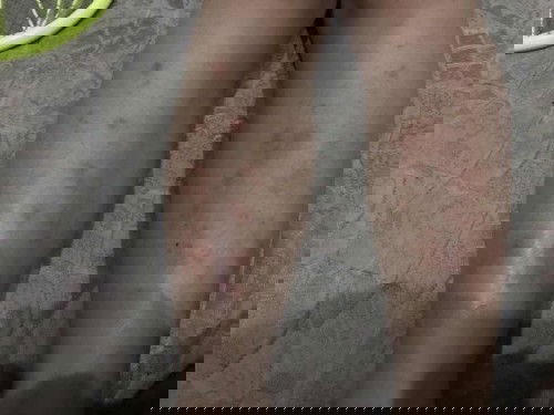 แม่คนไหนท้อง19wแล้วมีตุ่มเล็กๆคันๆขึ้นท้องมั้งคะ แล้วที่ขาก็เป็นผื่นคัน อยากทราบว่าเกิดจากอะไรคะ