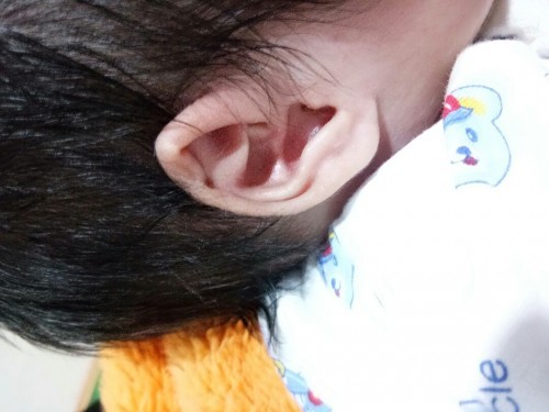 ลูกบ้านนี้หูติดค่ะ ต้องทำยังไงถึงหายคะ ลูกคนแรกค่ะ